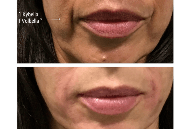 kybella rs=w 640